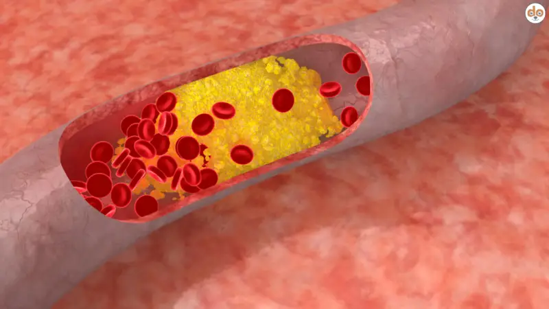 Cholesterinspiegel