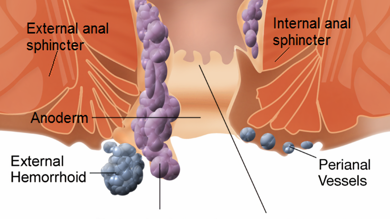 Haemorrhoids